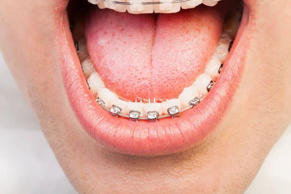 Geopende mond met orthodontische beugel — Stockfoto