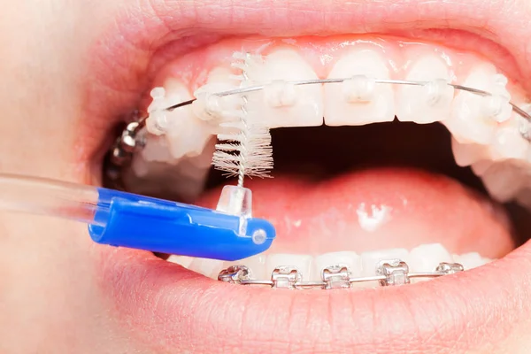 Pulizia uomo bretelle ortodontiche con spazzola — Foto Stock