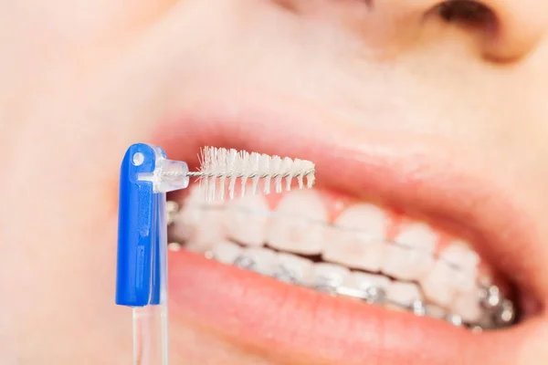 Man cleaning orthodontic braces with brush — Stock Photo, Image