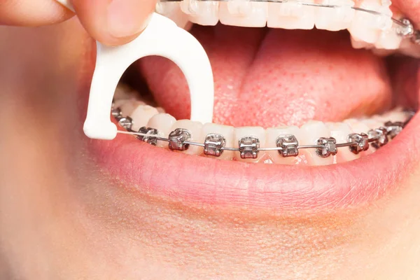 Hombre con frenos dentales dientes de hilo dental — Foto de Stock