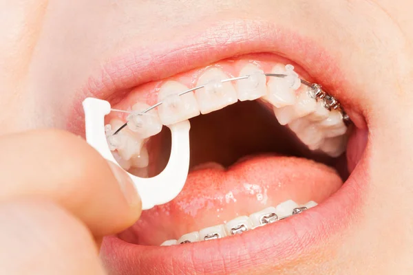 Hombre con frenos dentales dientes de hilo dental — Foto de Stock