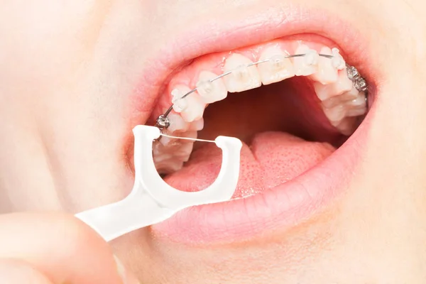 Homem com aparelho dentário dentes de fio dental — Fotografia de Stock