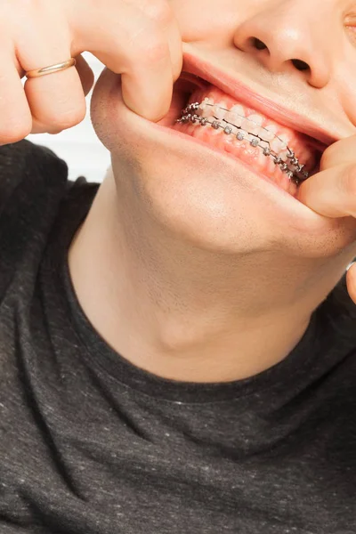 Широко улыбающийся мужчина с зубными скобками — стоковое фото