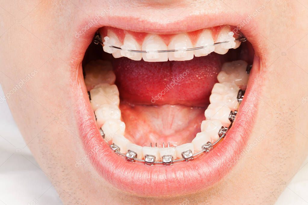 Opened mouth with orthodontic braces — Stock Photo © serrnovik 144801185