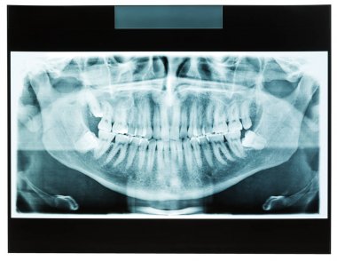 X-ray of man jaw with teeth clipart