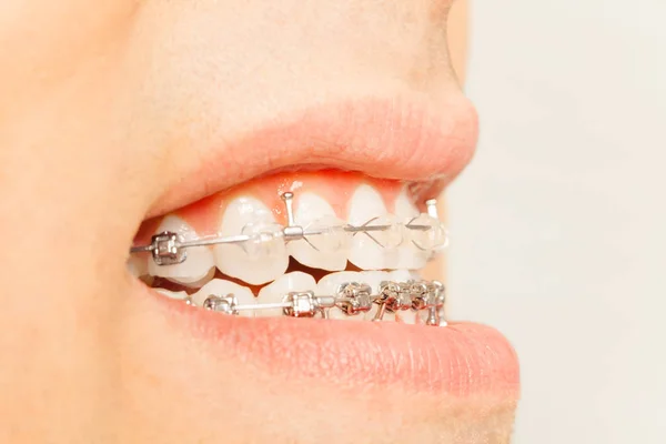 Nawiasy klamrowe na zęby w widoku profilu — Zdjęcie stockowe