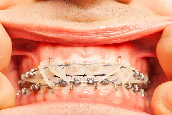 ortodontik kauçuk halka olan adam