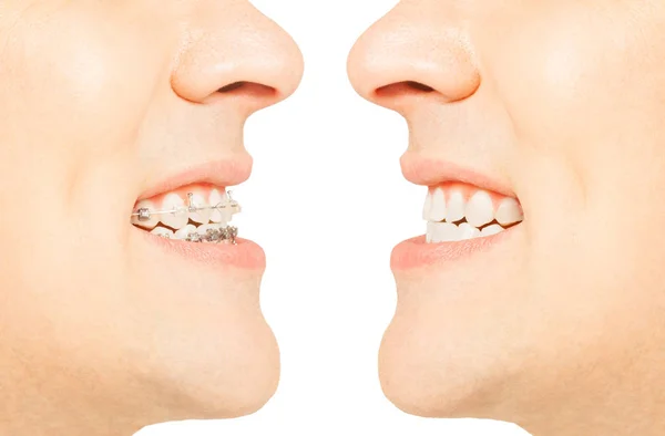 Before and after orthodontic treatment — Stock Photo, Image