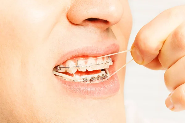 Рот мужчины с ортодонтическими брекетами — стоковое фото