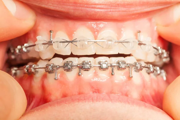 Man mond met orthodontische beugel — Stockfoto