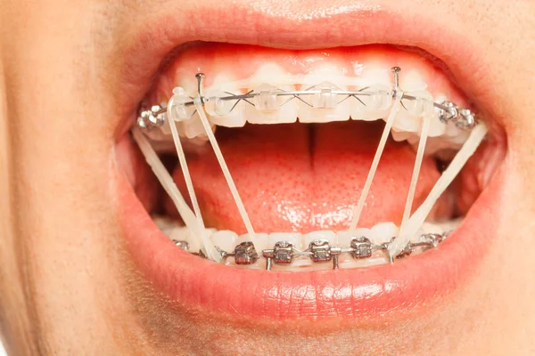 Muž s ortodontické gumovým kroužkem — Stock fotografie