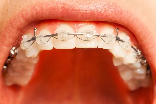 Man mouth with orthodontic braces — Stock Photo, Image