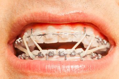 ortodontik kauçuk halka olan adam