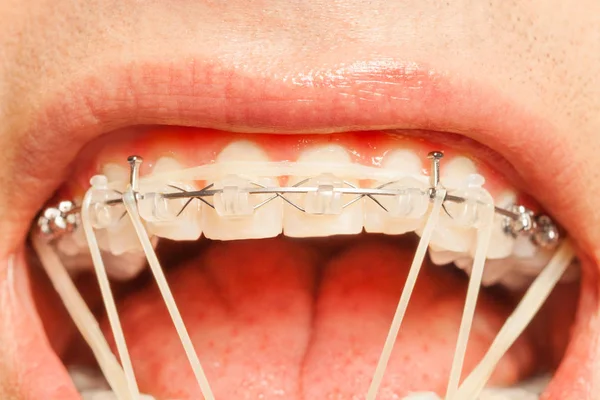 Man with orthodontic rubber ring — Stock Photo, Image