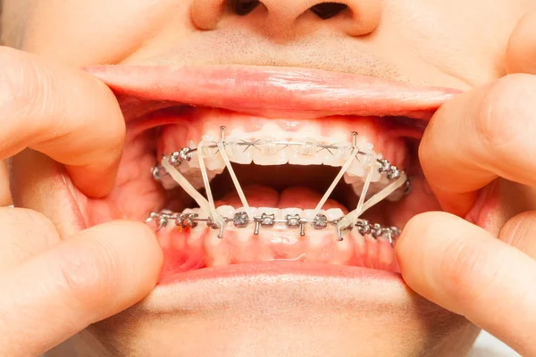 Man met orthodontische Rubberring — Stockfoto