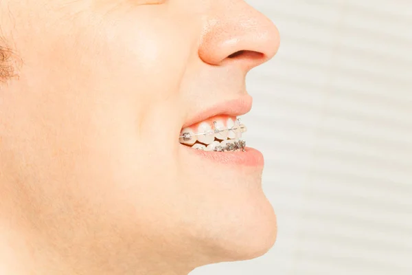 Bretelle sui denti in vista profilo — Foto Stock