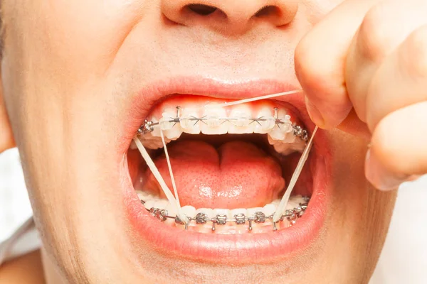 Man with orthodontic rubber ring — Stock Photo, Image