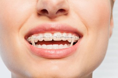 Close-up picture of womans mouth with orthodontic elastic bands on braces clipart