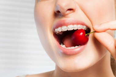 Woman with clear orthodontic brackets biting off ripe cherry clipart