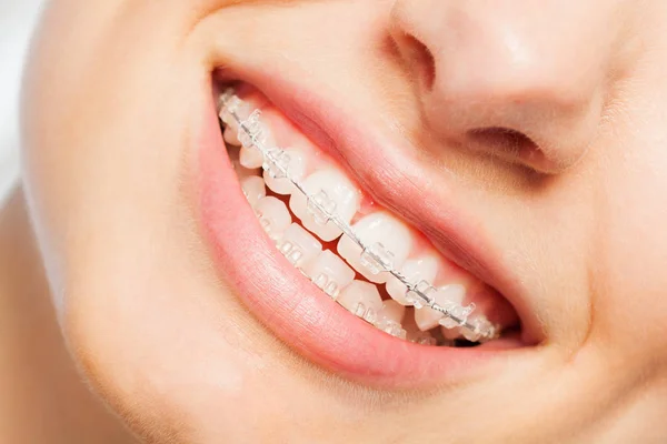 Zbliżenie Zdjęcie Womans Szczęśliwy Uśmiech Jasne Ortodontycznych — Zdjęcie stockowe