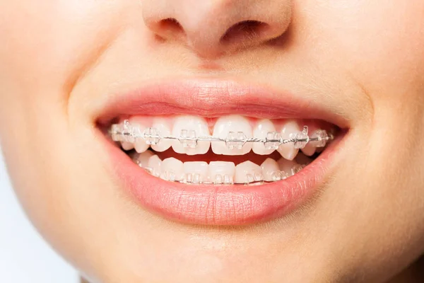 Close Foto Van Gelukkige Dames Glimlach Met Orthodontische Duidelijk Bretels — Stockfoto