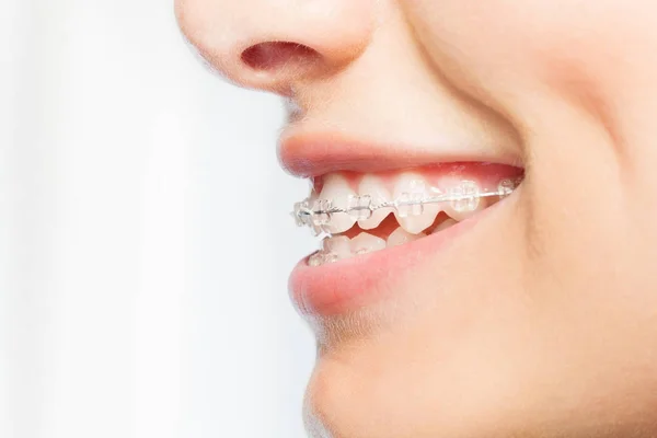 Immagine Vista Laterale Donne Sorridono Con Bretelle Dentali Bianco — Foto Stock