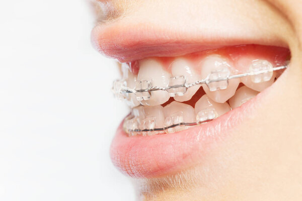 Side view picture of womans smile with dental braces on white