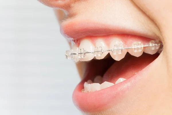 Imagen Vista Lateral Las Mujeres Sonríen Con Frenos Dentales Blanco — Foto de Stock