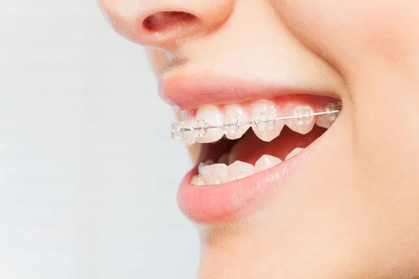 Imagen Vista Lateral Las Mujeres Sonríen Con Frenos Dentales Blanco — Foto de Stock