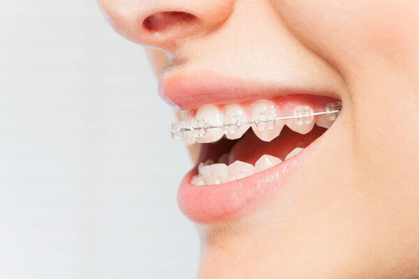 Side view picture of womans smile with dental braces on white