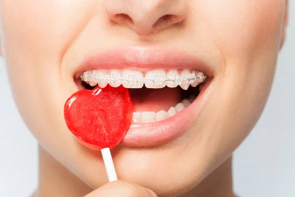 Close Portret Van Vrouw Met Orthodontische Duidelijk Haken Bijten Rode — Stockfoto