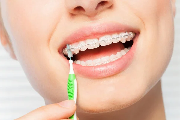 Detail Obrázku Ženy Používat Mezizubní Kartáček Pro Ortodontické Rovnátka — Stock fotografie