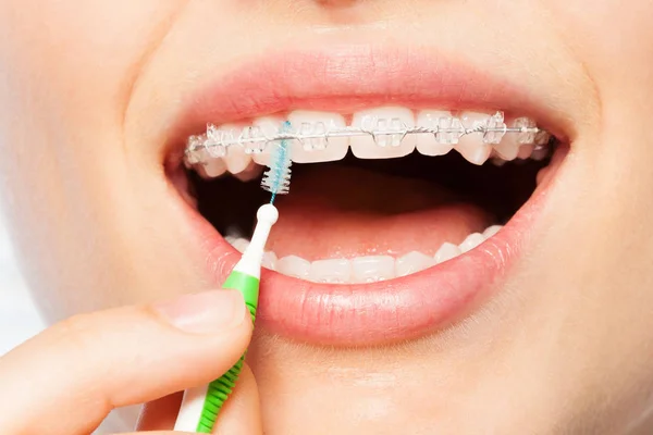Close Picture Woman Using Interdental Brush Orthodontic Braces — Stock Photo, Image