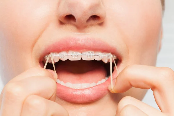 Vrouw Met Behulp Van Haar Vingers Dragen Orthodontische Elastische Banden — Stockfoto