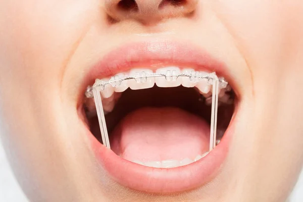 Close Foto Van Dames Mond Met Orthodontische Elastische Banden Bretels — Stockfoto