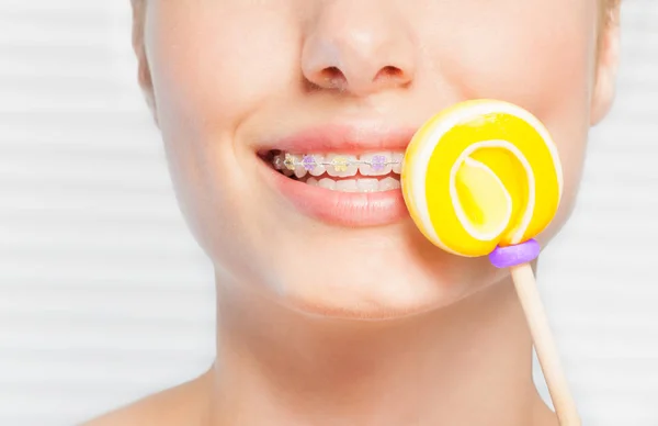Closeup Woman Colorful Orthodontic Brackets Holding Yellow Swirl Lollipop — Stock Photo, Image