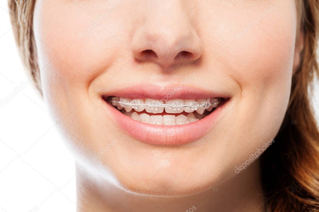 Close-up picture of happy womans smile with orthodontic clear braces