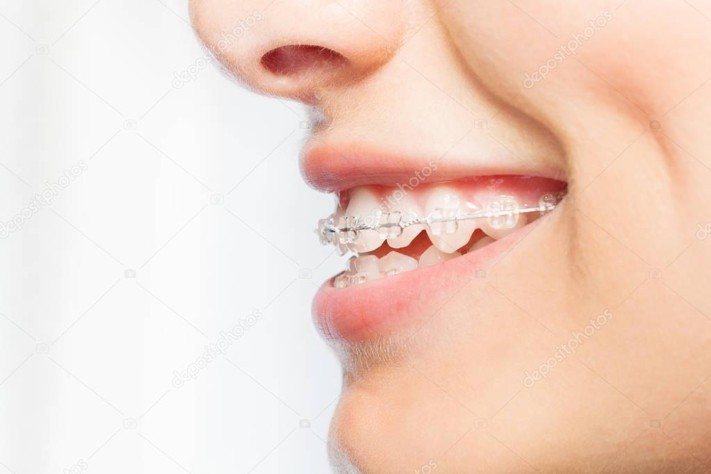 Side view picture of womans smile with dental braces on white