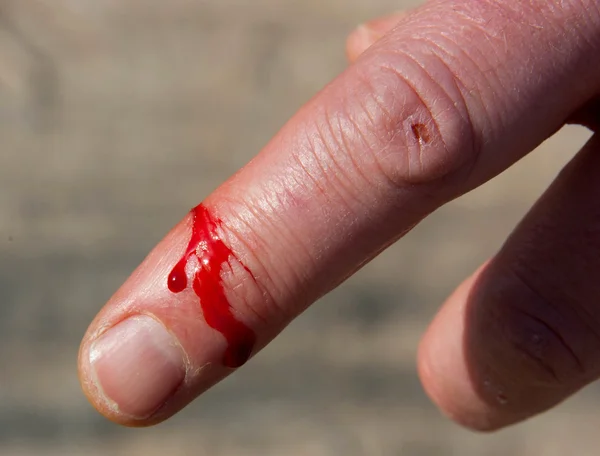 Порезанный палец — стоковое фото