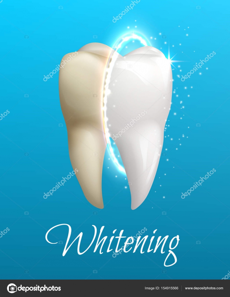 Teeth whitening concept with clean and dirty tooth — Stock Vector © Seamartini 154915566