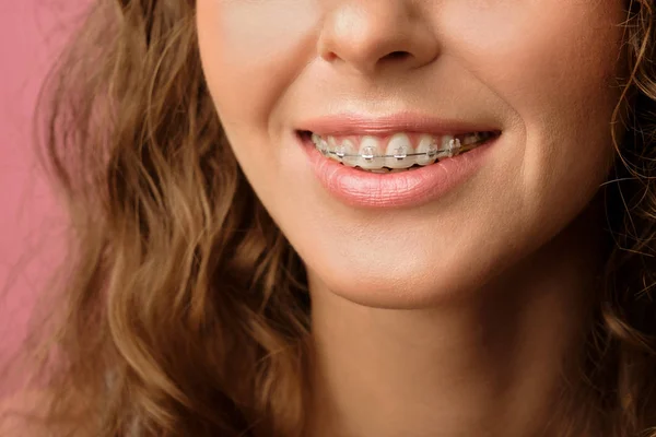 Closeup tiro de sorriso feminino bonita com aparelho dentário — Fotografia de Stock