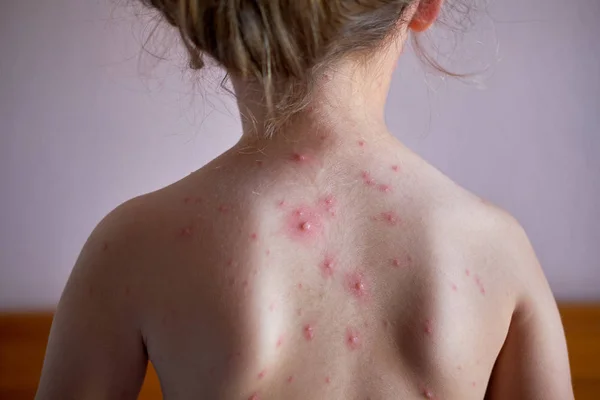 Little Girl Chickenpox Her Bac — Stock Photo, Image