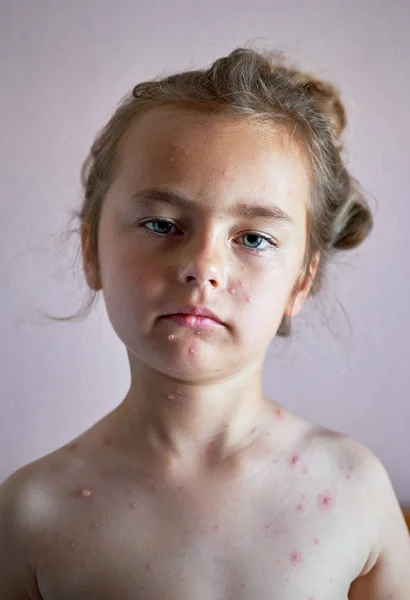 Retrato Uma Linda Menina Anos Com Varicela — Fotografia de Stock