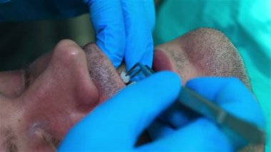 Diş hekimi diş implantı için hazırlar. Yakın çekim