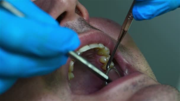 Дантист проверяет зуб пациента в клинике. Закрыть — стоковое видео