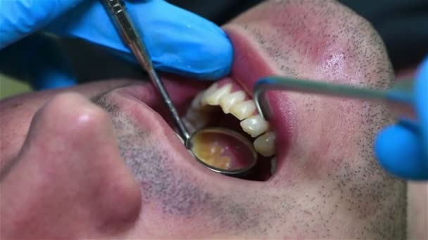 Zahnarzt überprüft Zahn des Patienten in Klinik. Nahaufnahme — Stockvideo