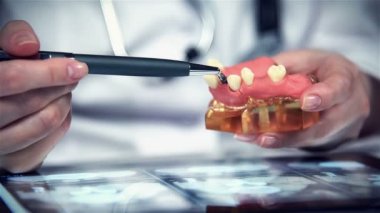 Diş hekimi diş protez Implant ile modeli gösterir
