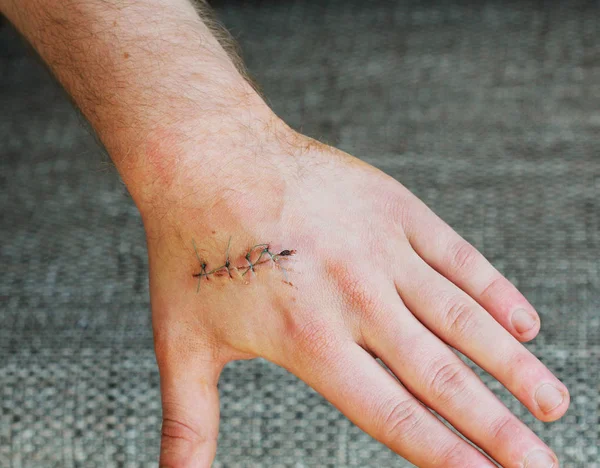 Karanlık dikiş el üstünde yara elinde. Ağrı kaza kavramının