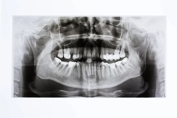 Raios-X da mandíbula e dentes — Fotografia de Stock