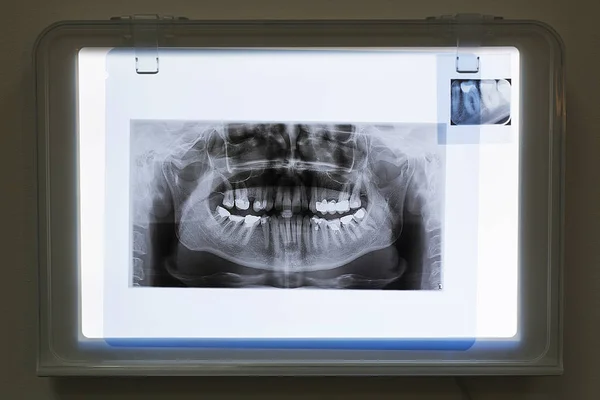 Radiografías de la mandíbula y los dientes —  Fotos de Stock